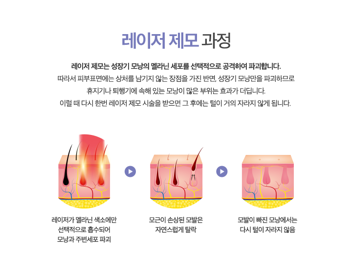 레이저 제모 과정