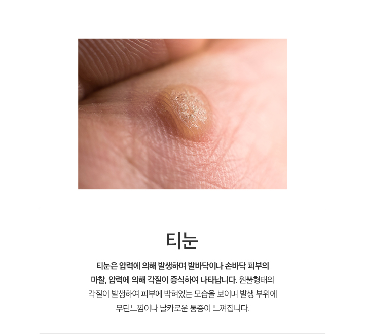 티눈